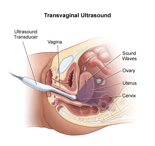 transvaginal-sonogram.gif
